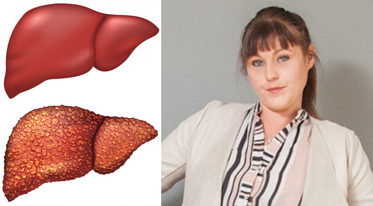 collagen Improves Liver Health