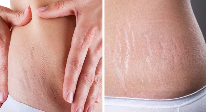 Stretch Mark Removal Inverness